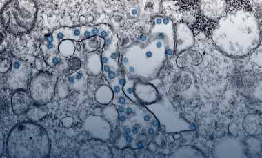 Transmission electron microscopic image from the first U.S. case of COVID-19. The spherical viral particles, colorized blue, contain cross-section through the viral genome, seen as black dots. (Credit: Centers for Disease Control and Prevention)