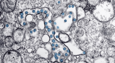 Transmission electron microscopic image from the first U.S. case of COVID-19. The spherical viral particles, colorized blue, contain cross-section through the viral genome, seen as black dots. (Credit: Centers for Disease Control and Prevention)