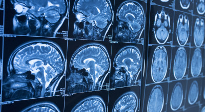 MRI images used to diagnose disease - iStock photo